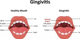 How to Get Rid of Gingivitis Fast