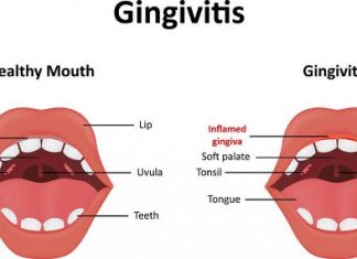 How to Get Rid of Gingivitis Fast