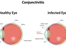 How to Get Rid of Pink Eye Conjunctivitis