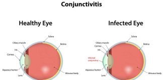 How to Get Rid of Pink Eye Conjunctivitis