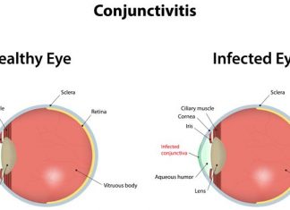 How to Get Rid of Pink Eye Conjunctivitis