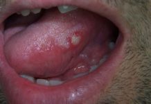 Home Remedies for Canker Sores on Tongue