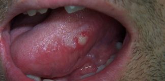 Home Remedies for Canker Sores on Tongue