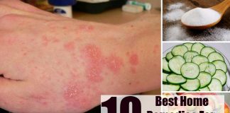 Home Remedies for Poison Ivy