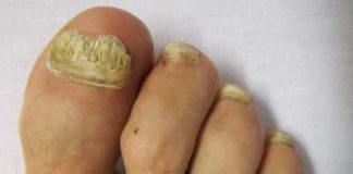 Home remedies for toenail fungus treatment