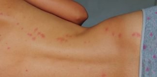 How to Get Rid of Bed Bug Bites