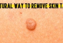 How to Remove a Skin Tag