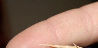 How to Remove a Splinter