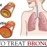 How to Treat Bronchitis