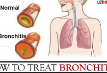 How to Treat Bronchitis