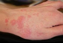 How to get rid of scabies
