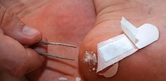 how to get a splinter out