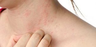 how to get rid of eczema