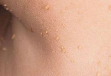 how to get rid of skin tags