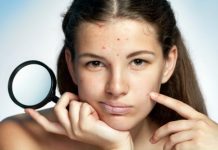 how to prevent acne