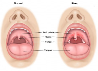 how to treat strep throat