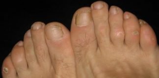 How to Get Rid of Corns Naturally