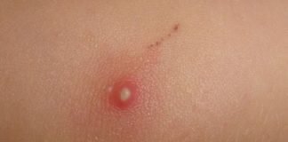 How to Get Rid of Boils