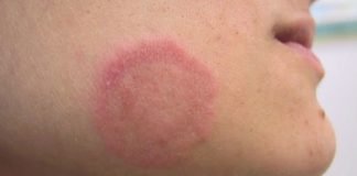 How Do You Get Ringworms