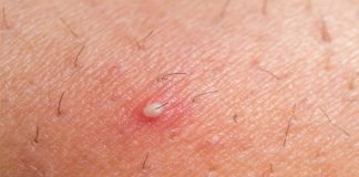 How to Get Rid of Boils