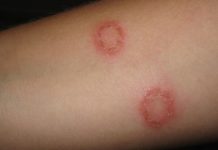 How to Get Rid of Ringworm Naturally