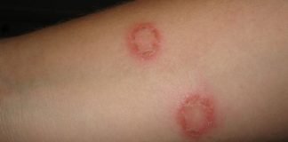 How to Get Rid of Ringworm Naturally