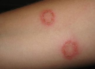 How to Get Rid of Ringworm Naturally