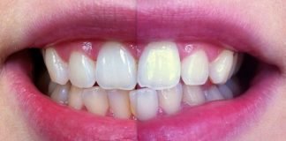 How to Whiten Your Teeth