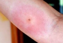 Home remedies for spider bites treatment