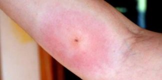 Home remedies for spider bites treatment