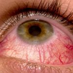How to Cure Pink Eye