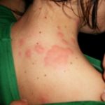 how to get rid of bed bug bites naturally fast