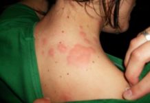 how to get rid of bed bug bites naturally fast