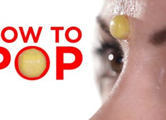 how to pop a pimple
