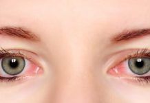 natural remedies for pink eye treatment