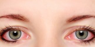 natural remedies for pink eye treatment