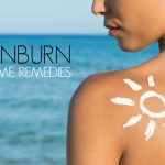 Home Remedies for Sunburn