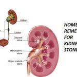 Home remedies for kidney stones