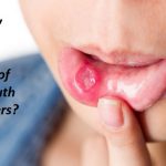 How to Get Rid of Mouth Ulcers