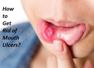 How to Get Rid of Mouth Ulcers