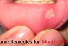 home remedies for mouth ulcers