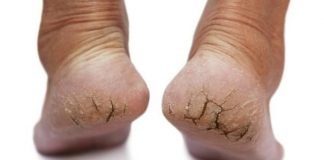 home remedies for cracked heels