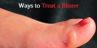 treat a foot blister
