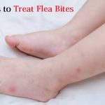 treat flea bites