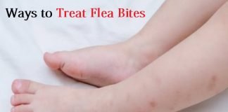 treat flea bites